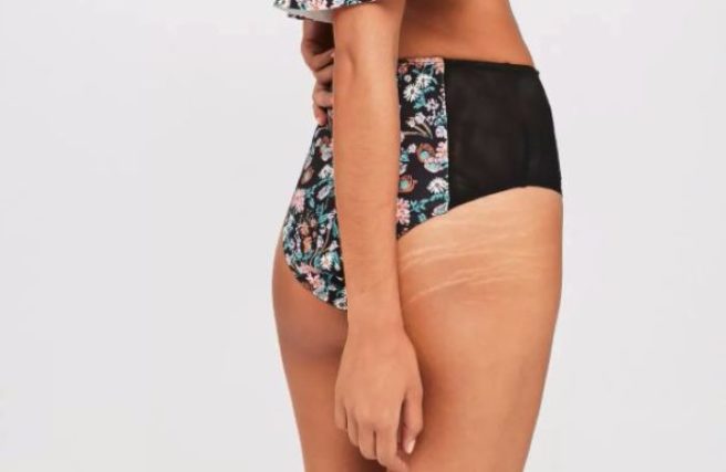 Missguided praised for ceasing to edit out models’ stretch marks