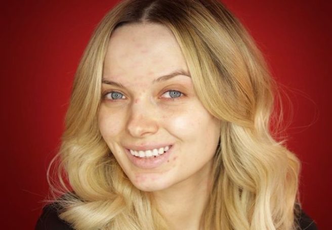 #SkinPositivity: Embracing your acne in this Instagram movement