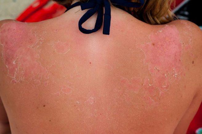Sunburn solutions: 5 simple ways to treat your damaged skin at home