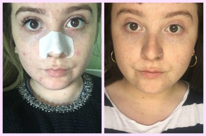 This cleanser took my skin from acne ridden to clear AF – for €15