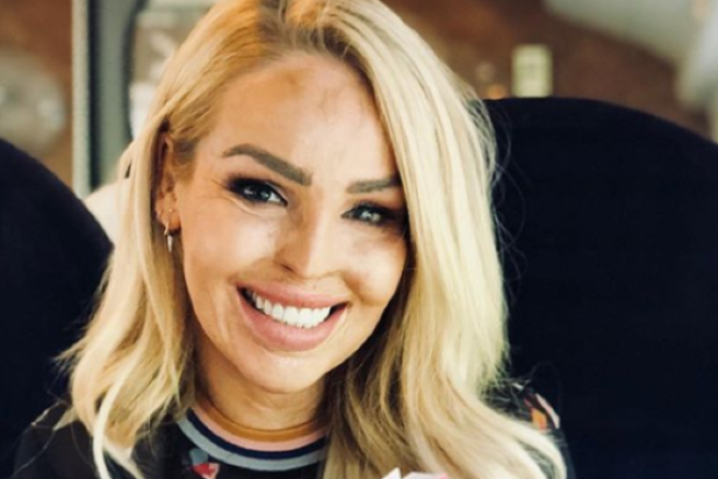 WMHD: Katie Piper posts harrowing photo of her acid attack injuries