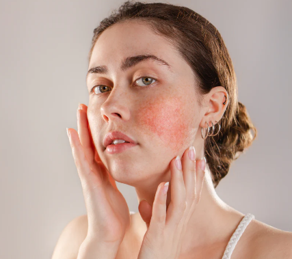 For the one in ten people that suffer from Rosacea, French brand Avène is the answer