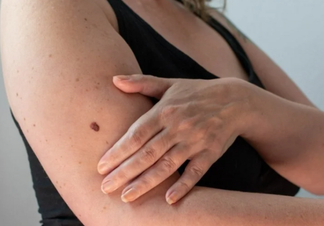 Irish Cancer Society pleads for cheaper suncream amid skin cancer rise