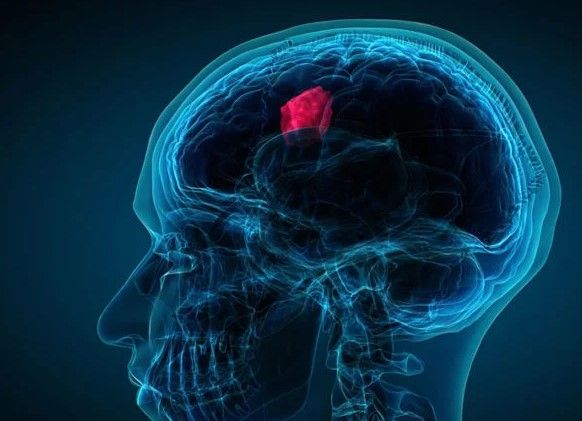 True or False: Top 5 things to know about brain tumours
