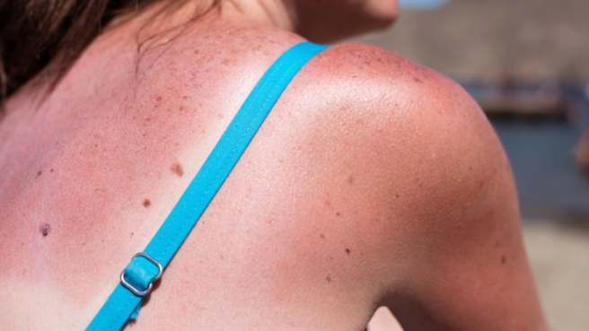 Irish skin expert’s urgent warning to sun worshippers this heatwave