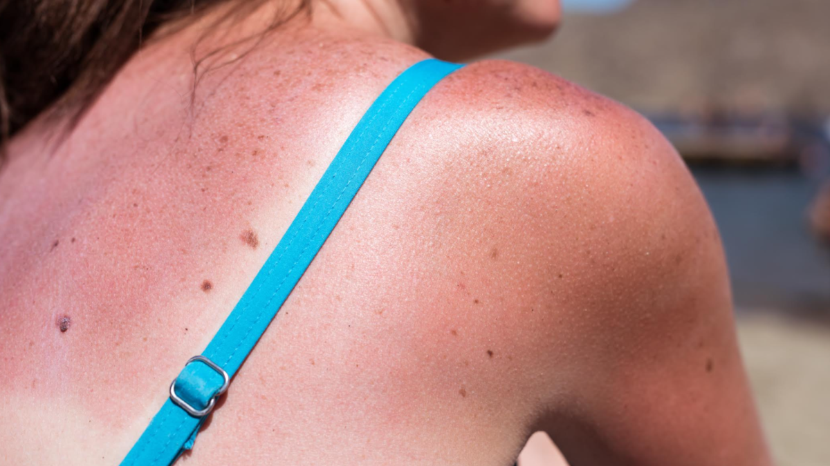Irish skin expert's urgent warning to sun worshippers this heatwave